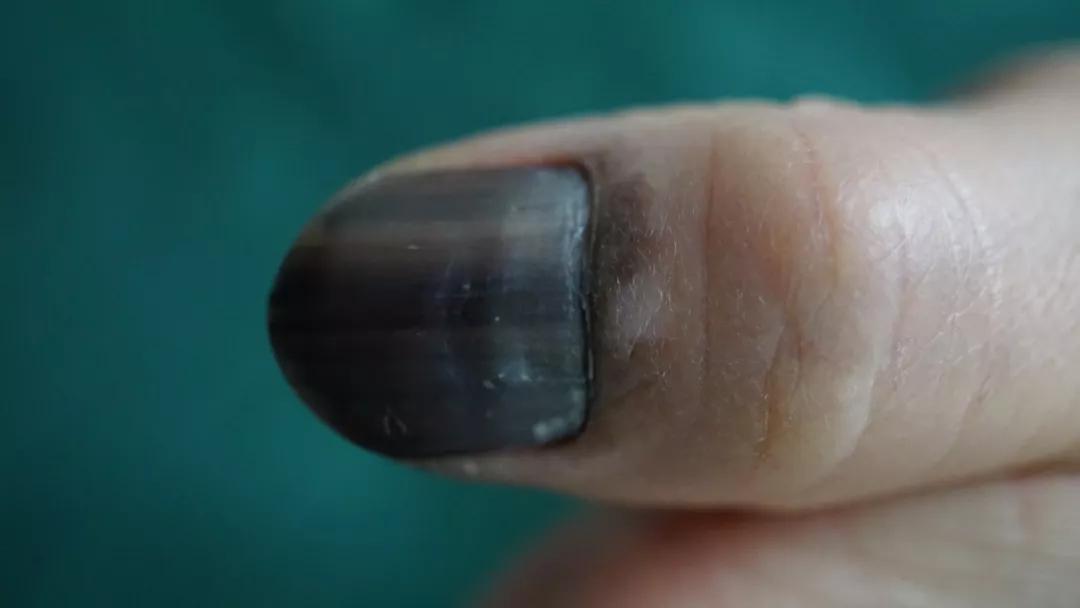 痣能点吗,我的痣凸起来会癌变吗