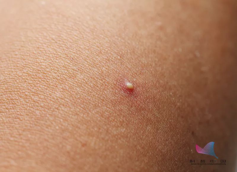 后背疙瘩去除视频,后背粉刺疙瘩怎么去除