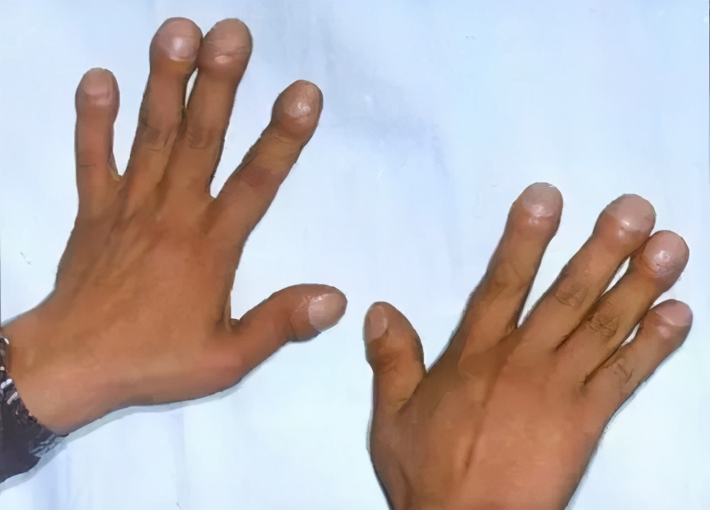 脑垂体病变的面相图解,脑垂体腺瘤面相图片