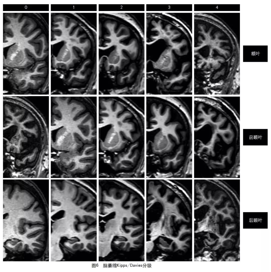 容易被误诊漏诊的脑小血管病,脑小血管病的基础知识