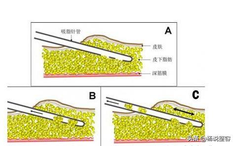 大腿吸脂术前要做检查多少钱,俩胳膊俩大腿做吸脂手术要多少钱