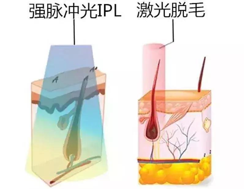 现在美容最火项目,激光脱毛品牌推荐美容院