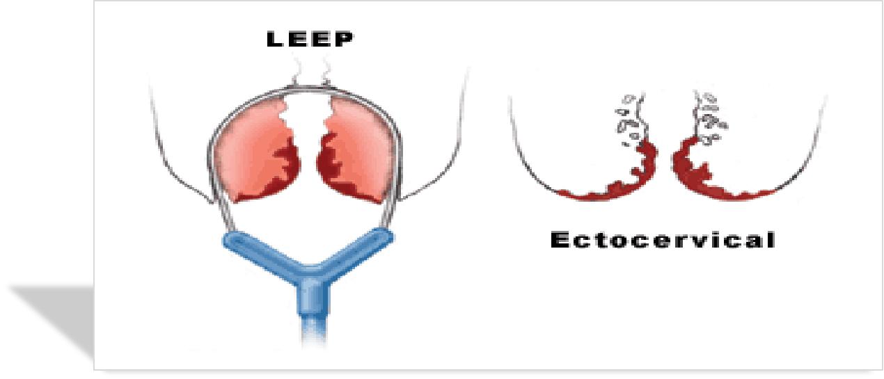 宫颈病变的诊断和治疗,宫颈病变的诊断和治疗华医网