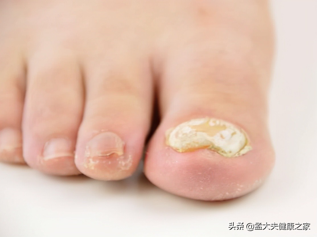 得了灰指甲怎么办才能治好,得了灰指甲怎样才能彻底治疗呢