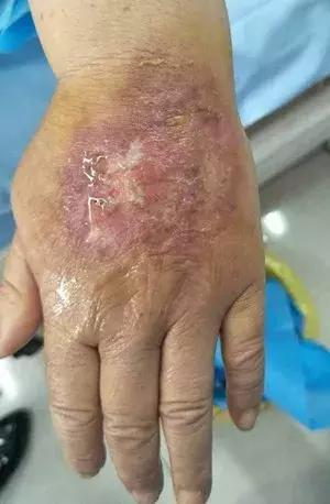 多柔比星副作用多久消除,多柔比星是最后治疗方案吗