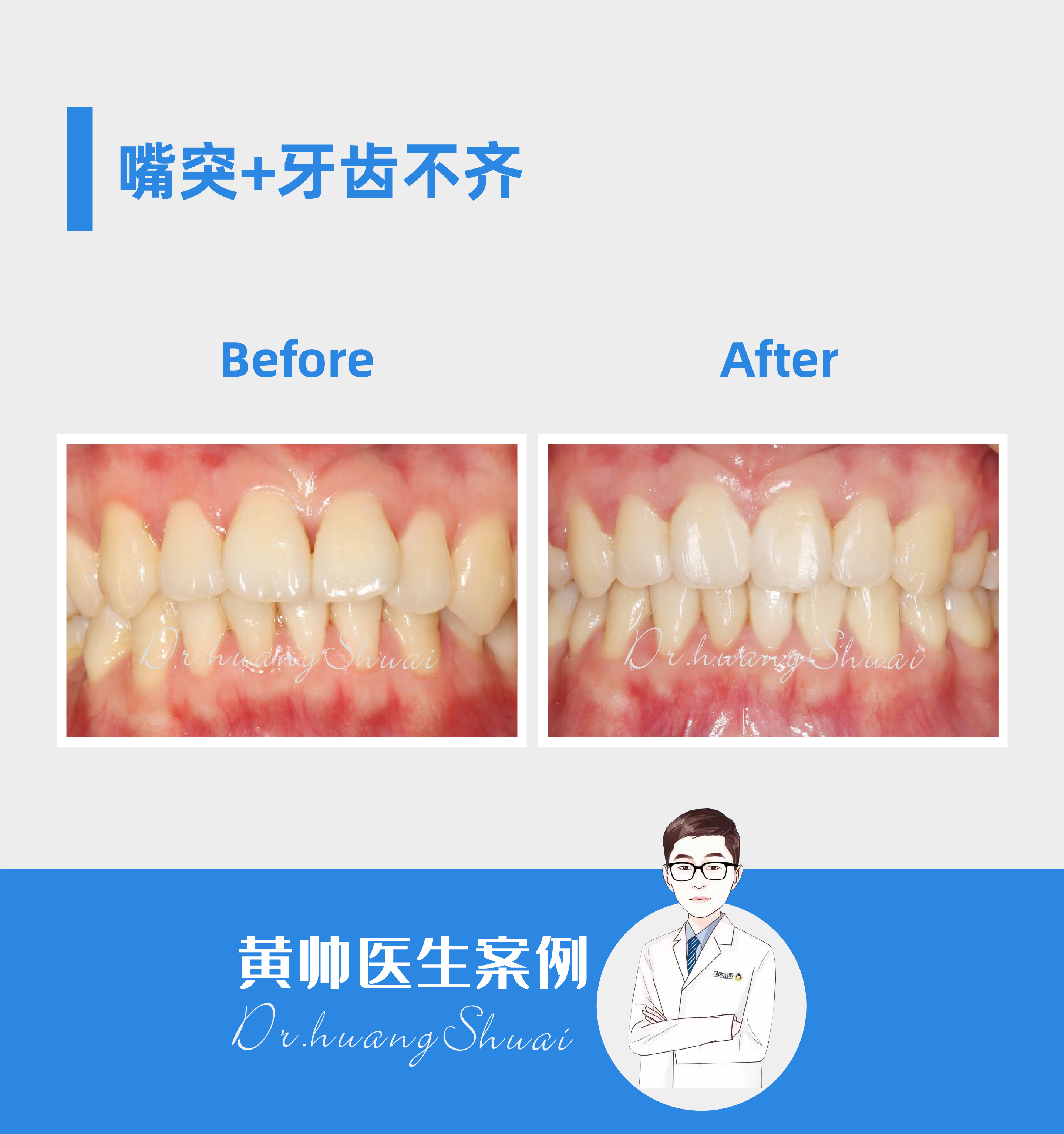 嘴凸牙齿矫正前后对比视频,牙齿矫正拔智齿可以怎样改善嘴凸