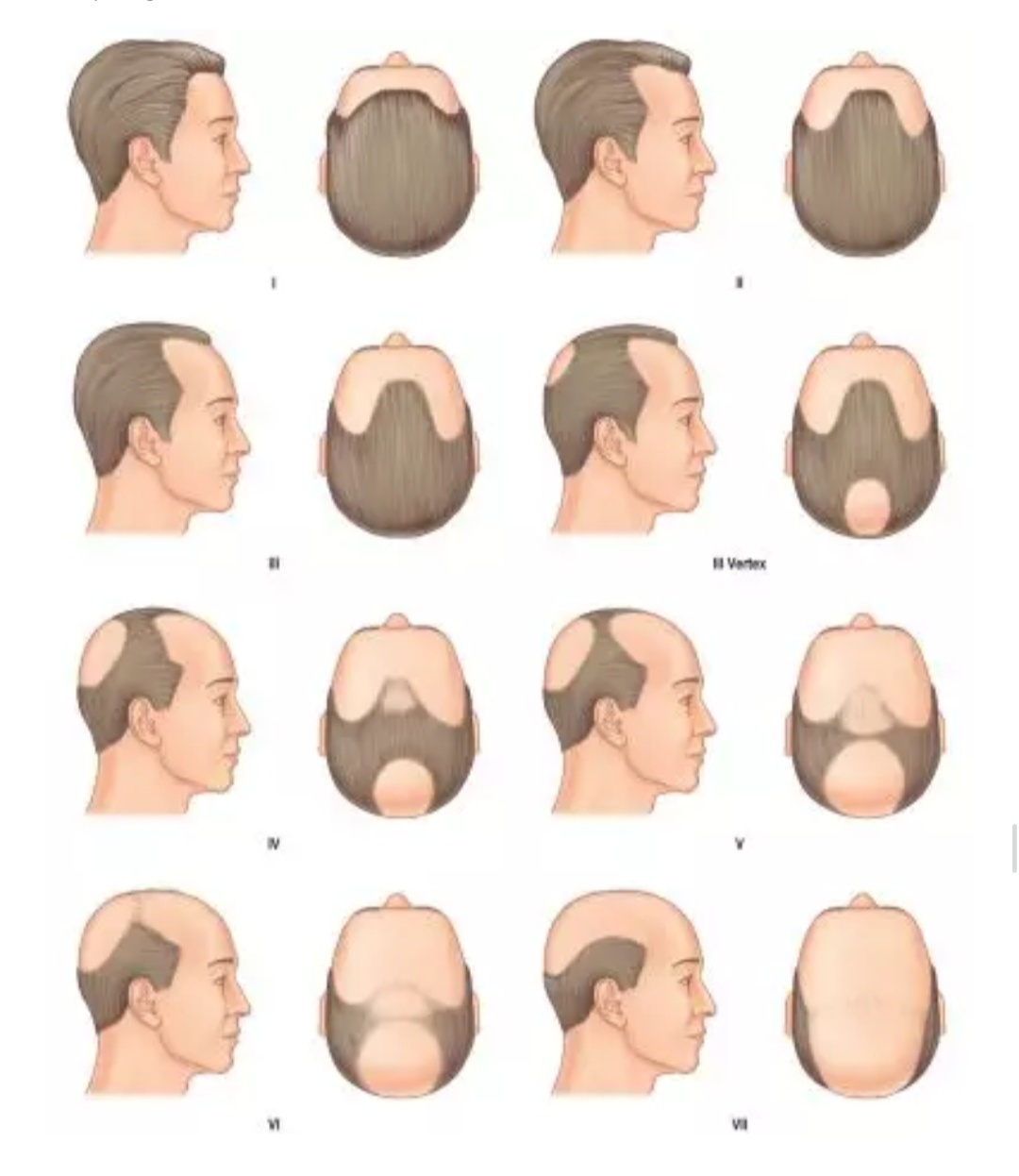 脱发秃顶严重怎么调理男,男士怎么防脱发秃顶