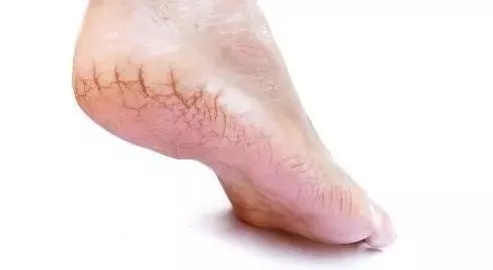 脚后跟鱼鳞状干裂用什么药,小腿后跟干裂起鱼鳞是什么原因