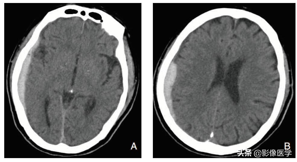 非外伤性硬膜下血肿死亡病例讨论,硬膜下血肿病例