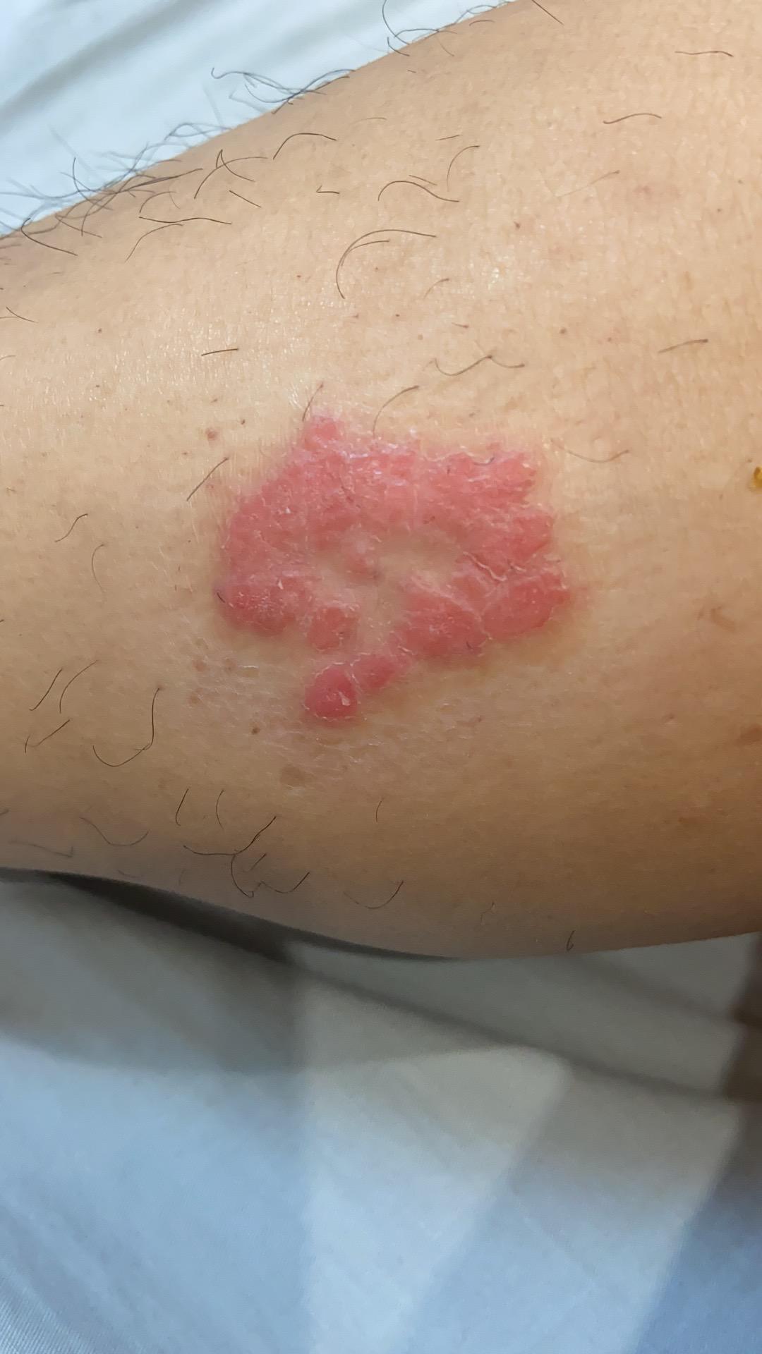 关于银屑病患者在冬季的注意事项,银屑病打生物制剂以后饮食要注意