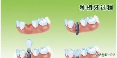 烤瓷牙价格表图种植牙,种植牙与烤瓷牙利与弊