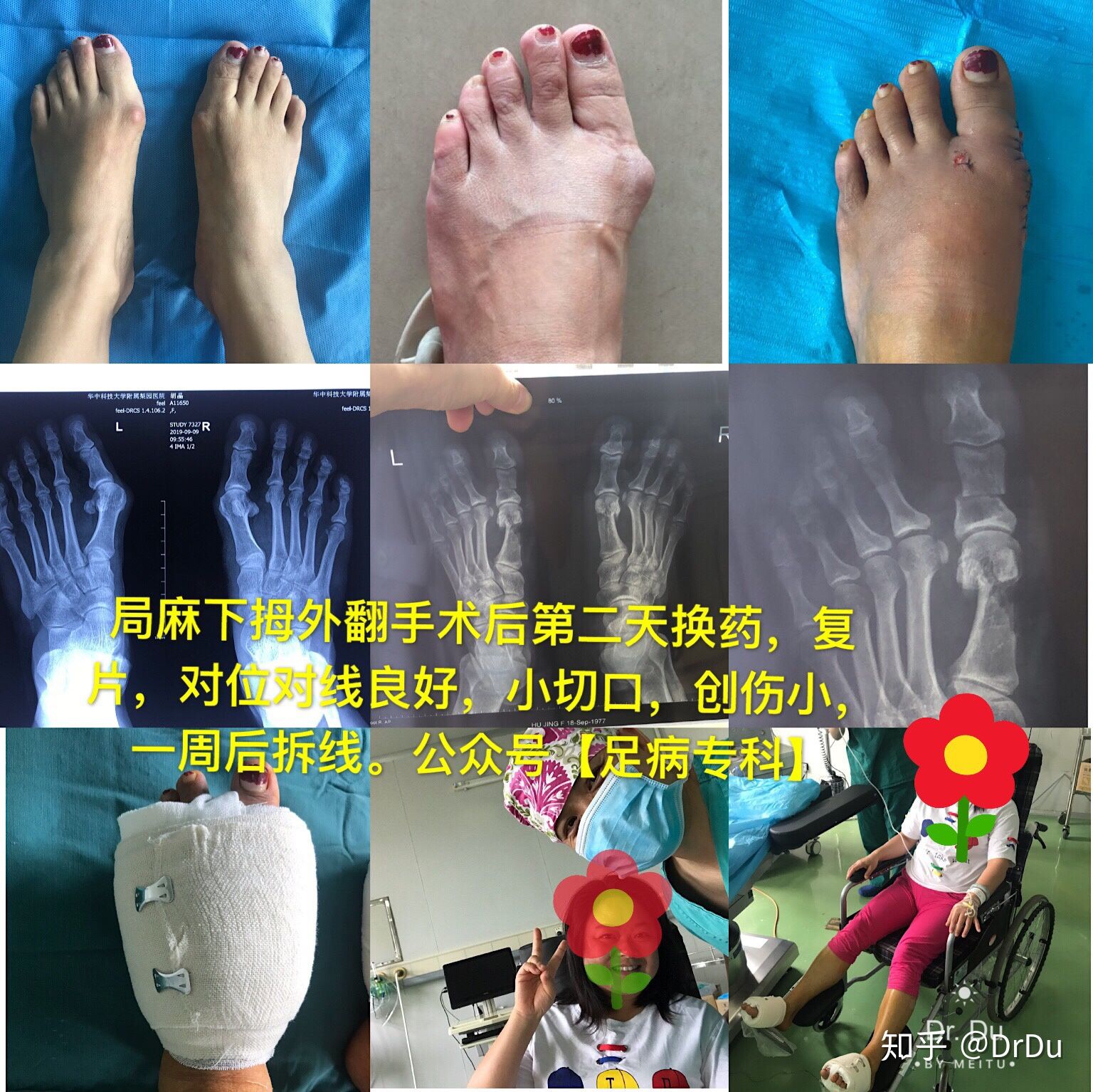 拇外翻微创手术的全过程,医生自己给自己做拇外翻手术