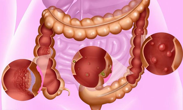 老人大便拉不来有痔疮怎么治,80岁的老人痔疮经常掉出来怎么办