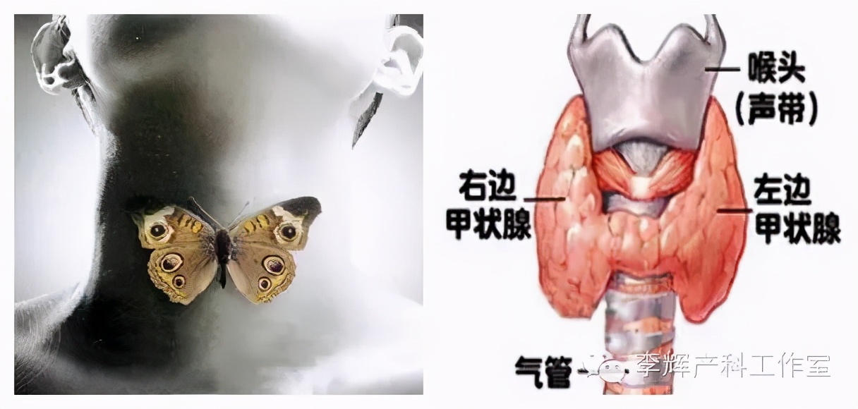 妊娠期甲状腺功能亢进诊断标准,甲状腺功能亢进症的最佳治疗方法