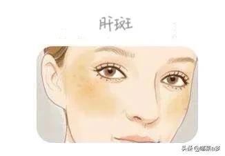 雀斑晒斑怎么去除中医,晒斑怎么祛斑最有效既省钱又简单