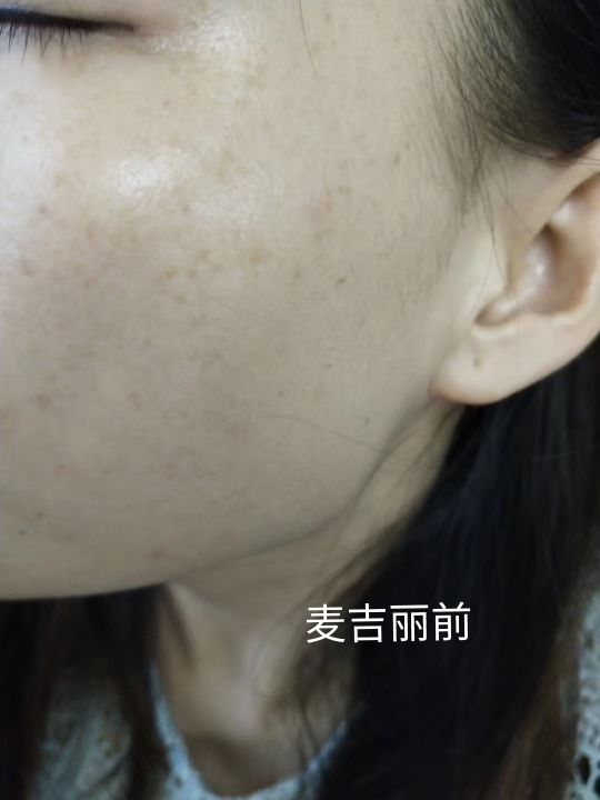 甜甜专业祛斑祛痘,甜甜祛斑直播间