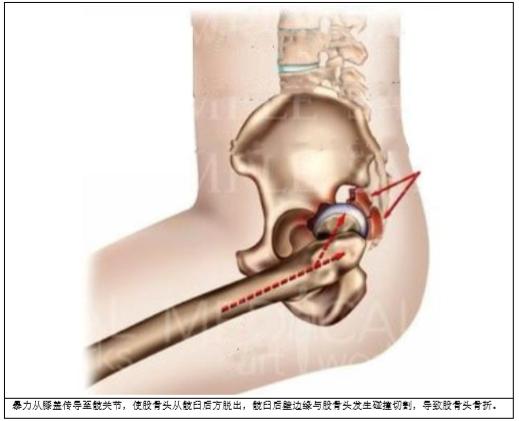 pipkin骨折,pipkin的视频