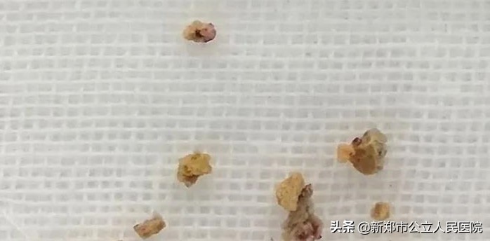 尿结石腰疼说明石头在哪里卡着呢,腰疼得厉害小便血尿是怎么回事