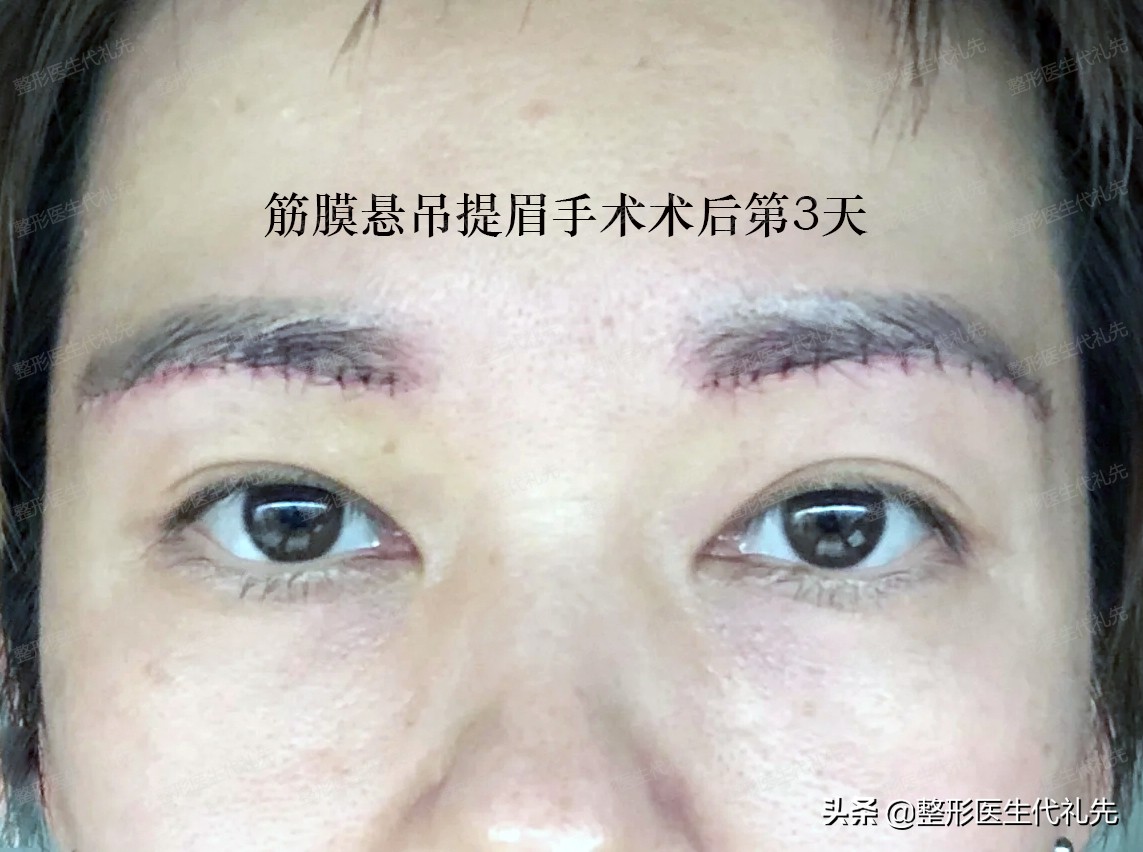 提眉筋膜悬吊和去眼袋术后视频,筋膜悬吊提眉术后显老
