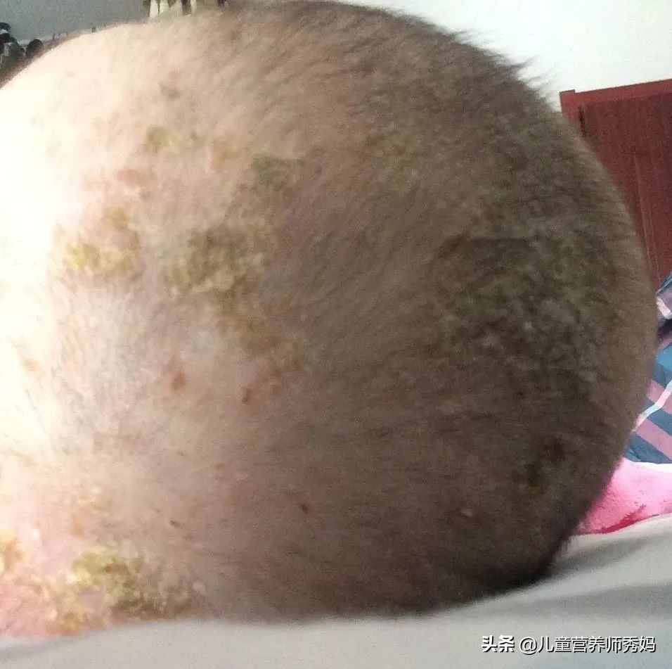 湿疹有时反复发作吃什么药最好,湿疹严重万一治不好后果会怎样