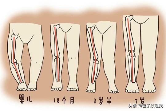 o型腿宝宝x型腿怎么判断,怎么判断孩子的腿是不是o型腿