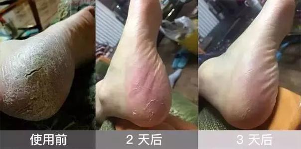 冬天手脚粗糙开裂小妙招,冬季手脚干裂怎么快速修复