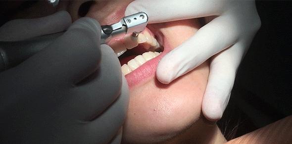 宝宝牙齿还能用护牙素吗,宝宝牙齿防护