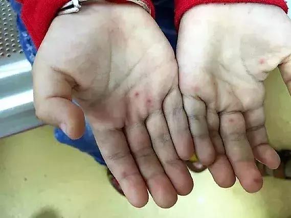 手足口喝利巴韦林管用吗,利巴韦林可以治手足口吗