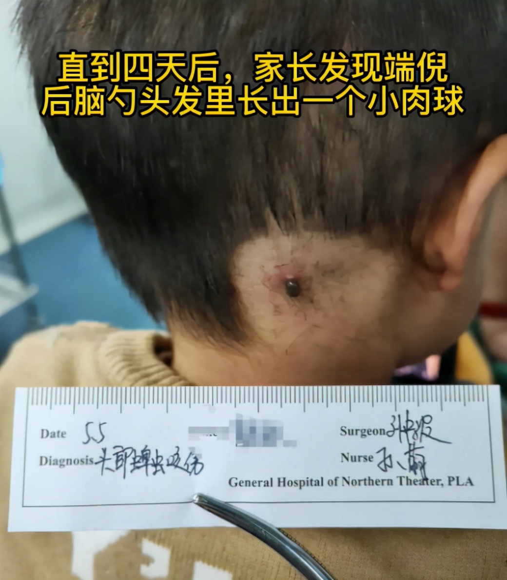 孩子被蚊虫咬了怎么办最有效,儿童被蚊虫叮咬可能引发的疾病