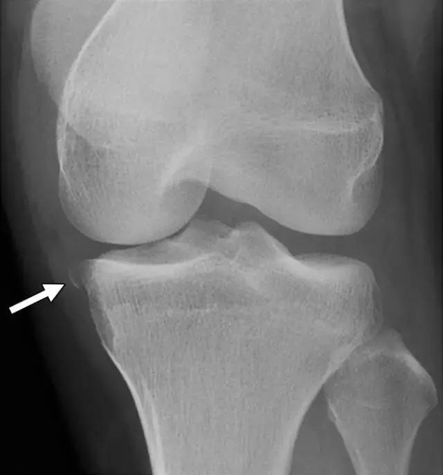 骨折处出现麻痹感,骨折跟精神状态有关
