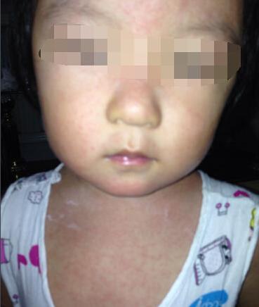 天热没空调婴儿怎么预防热痱子,宝宝热出痱子还不能吹空调吗