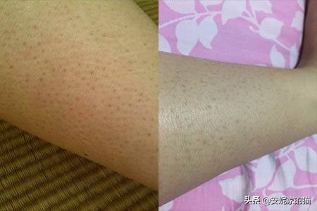皮肤一摸就跟鸡皮一样,脸上出现鸡皮肤和小红点