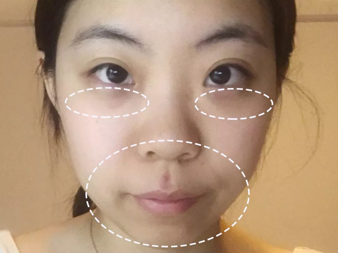 求改善痘痘真实办法,想改变脸上痘痘