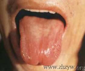 中医看舌头知病情图片,看舌头知病情图解大全