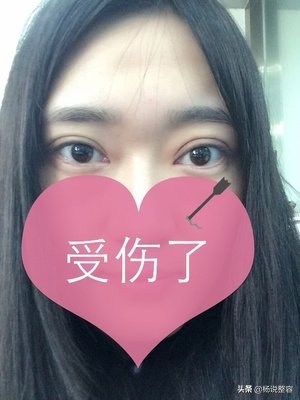 全切双眼皮是永久的么,全切双眼皮是永久吗