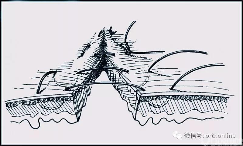 十种外科基本缝合方式详解,手术切口缝合有哪几种