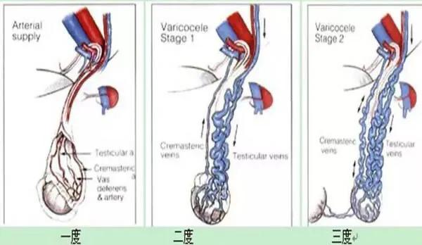 检查发现精索静脉曲张,查出精索静脉曲张怎么办