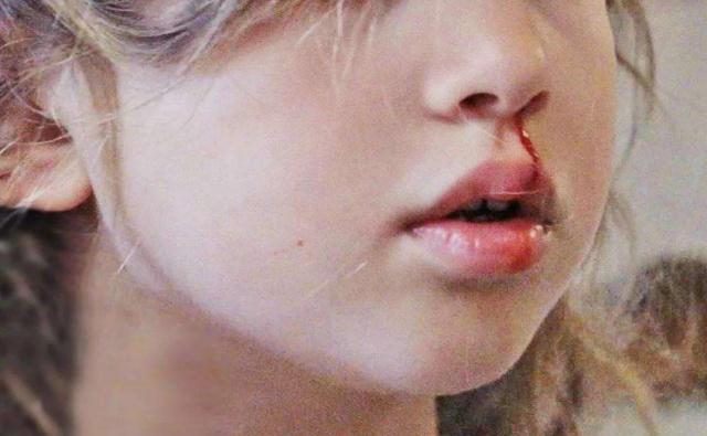 孩子流鼻血仰头了怎么办,孩子流鼻血要仰头吗