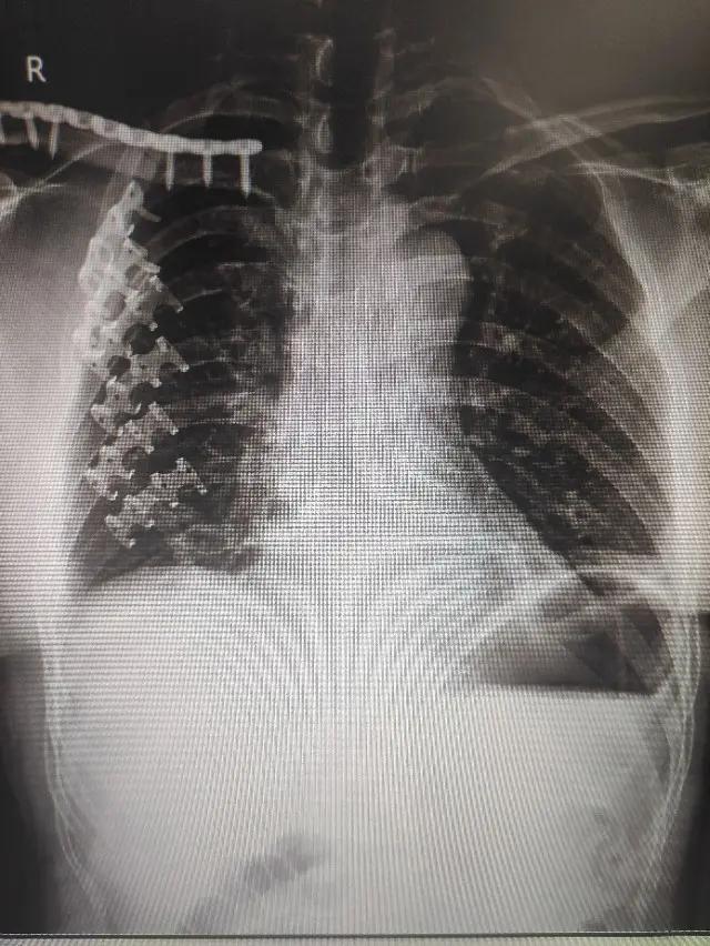 肋骨骨折手术愈后发生哪些后遗症,肋骨骨折切开内固定术是几级手术