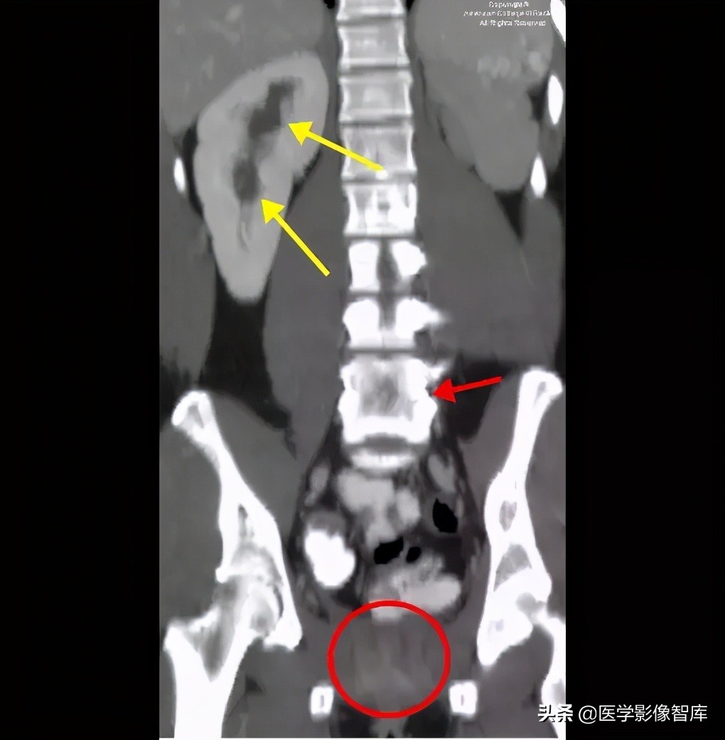 先天性无阴道综合征的影像诊断