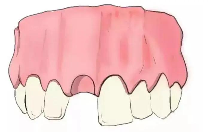 传统的种植牙和即刻种牙的区别,什么是种牙方法