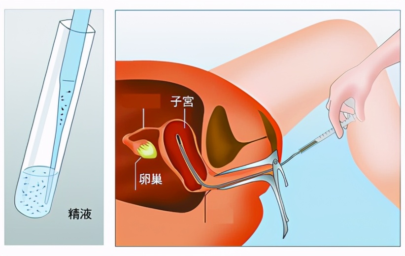 常见的辅助生殖技术,辅助生殖技术纳入医保项目有哪些
