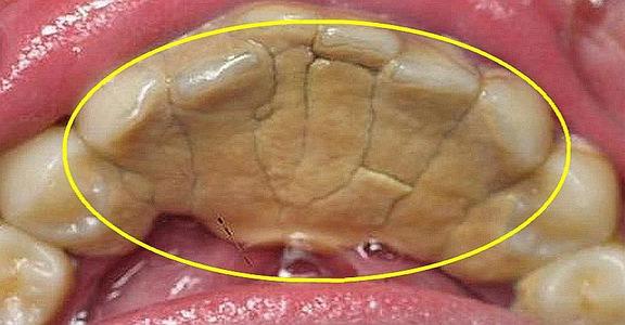 智齿蛀牙痛有什么有效方法止痛,智齿旁边牙松动蛀牙如何处理