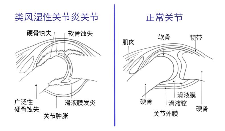 类风湿关节炎要怎么治效果最好,手指类风湿性关节炎最新治愈方法