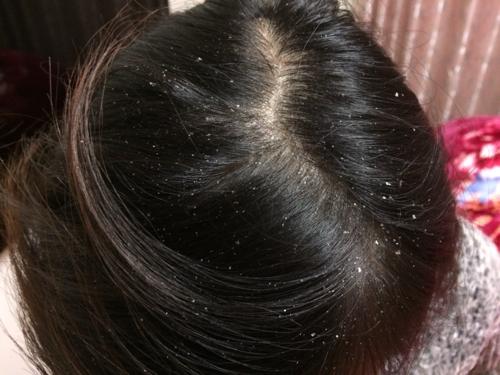 有头屑头皮痒怎么解决小妙招,头屑多头皮痒什么原因怎样解决