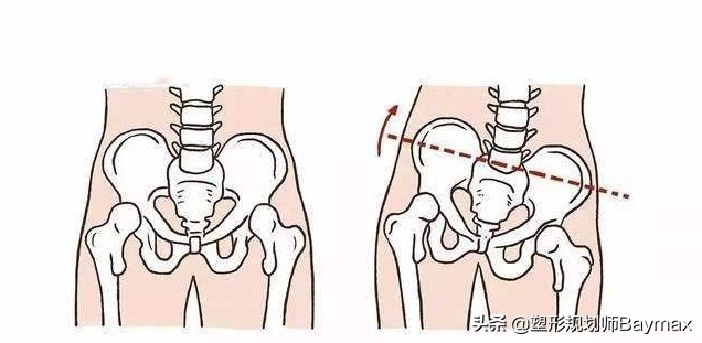 骨盆前倾脊柱侧弯高低肩如何调整,男士高低肩骨盆前倾体态矫正训练