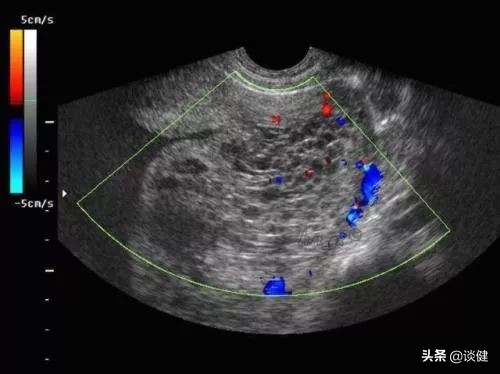 怀孕初期出血是不是宫外孕流产了,宫外孕和自然流产出血的区别