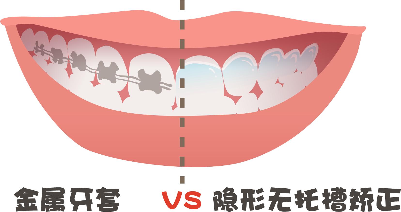 牙齿矫正各地价格区别,牙齿矫正的价格大概多少