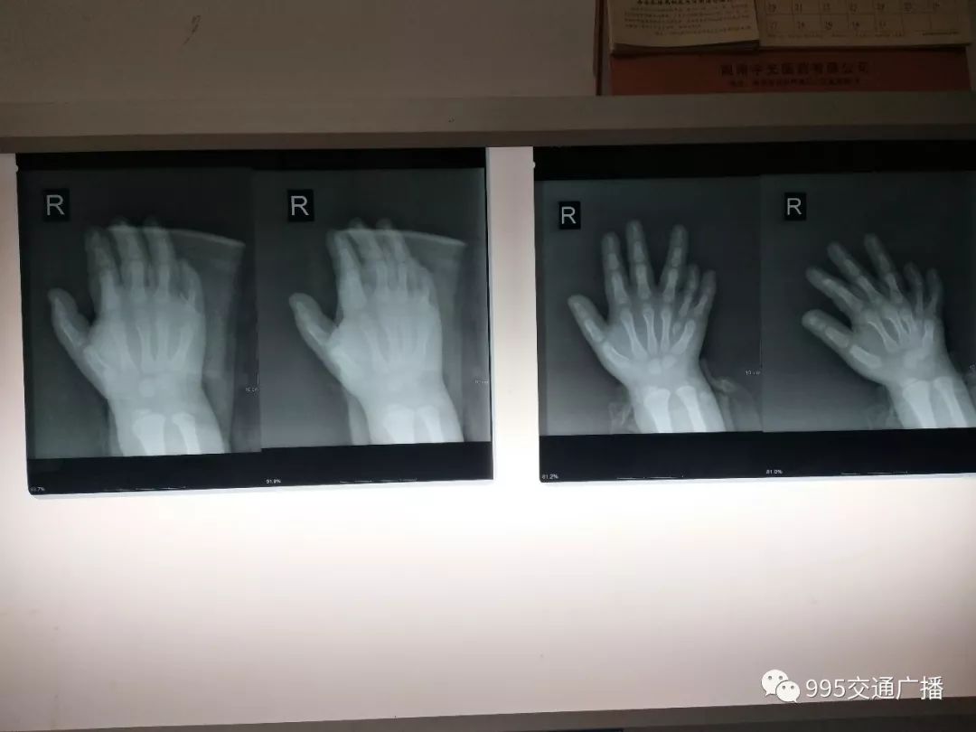 浏阳医院婴儿,小孩出生只有四根手指做手术