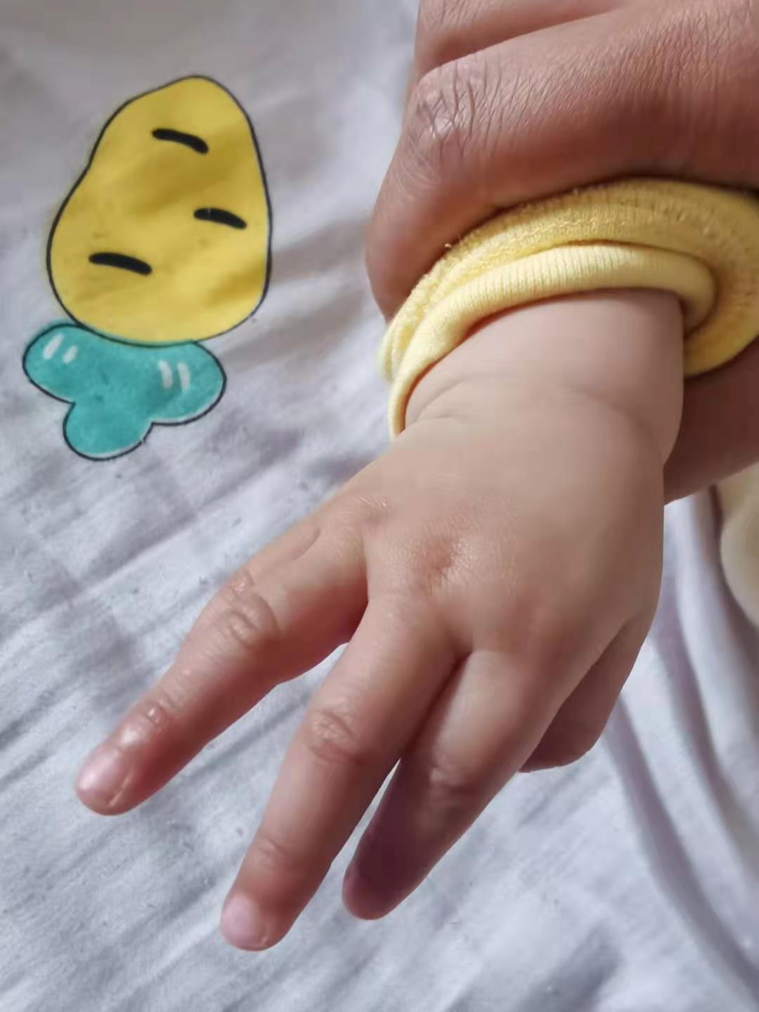 孩子的手过敏红肿怎么办,五个月宝宝手红肿了怎么回事